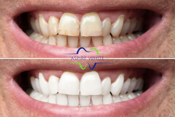 Before and after whitening results Nottingham